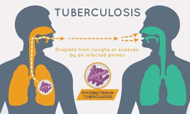 Dinkes Madiun Tangani 5 Ribu Lebih Penderita Tuberculosis