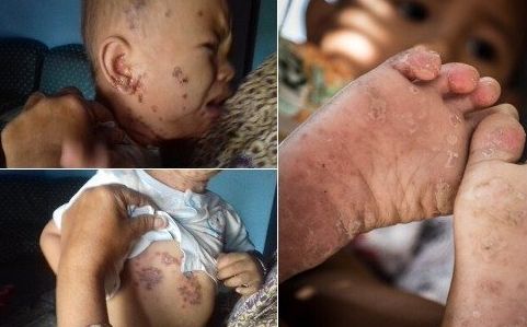 Petisi Jauhkan Anak Lakardowo dari Limbah Beracun Menggema